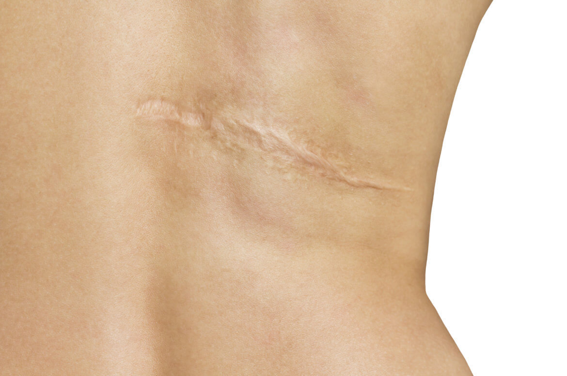 Scar And Recovery Tips What To Expect After Liposuction Liposuction Vs Coolsculpting 